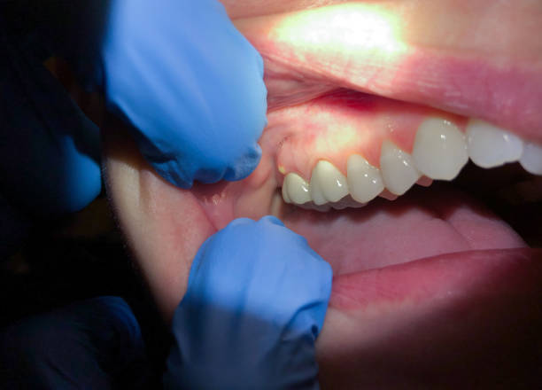 Best Emergency Denture Repair in East Milton, FL