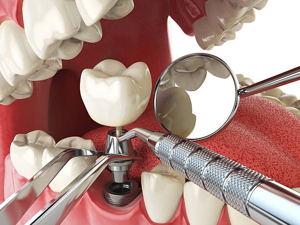 Best Broken or Chipped Tooth Repair in East Milton, FL
